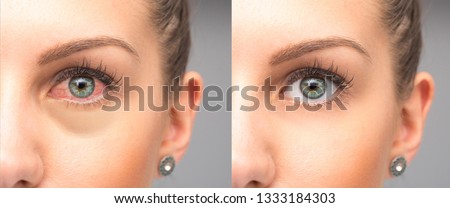 Woman red eyes before and after eye drops wash Royalty-Free Stock Photo #1333184303