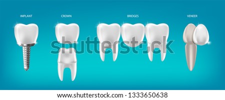 Dental prosthetics vector illustration, implant, crown, bridge, veneer. 3d Realistic dental Banner. Teeth Procedure of Implant Veneer bridge Crown Restoration.