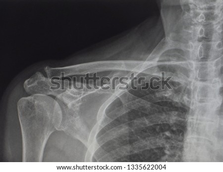 an anteroposterior radiograph or x-ray of shoulder showing normal bone and joint. this patient has frozen shoulder or adhesive capsulitis. Royalty-Free Stock Photo #1335622004