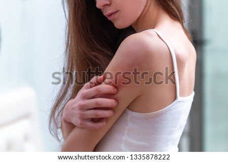 Young woman suffering from itching on her skin and scratching an itchy place. Allergic reaction to insect bites, dermatitis, food, drugs. Health care concept. Allergy rash  Royalty-Free Stock Photo #1335878222