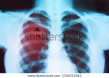 
X-ray of the lungs of a sick person