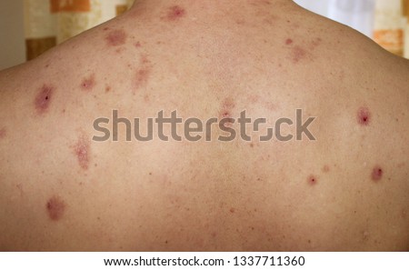 A case of psychogenic (neurotic) skin excoriation in a young man. Royalty-Free Stock Photo #1337711360