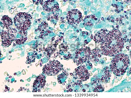 Microscopic of disseminated histoplasmosis, a type of fungal infection  by the fungus Histoplasma capsulatum.  Yeast forms appear as black  spherules within the cytoplasm of macrophages. GMS stain.  Royalty-Free Stock Photo #1339934954