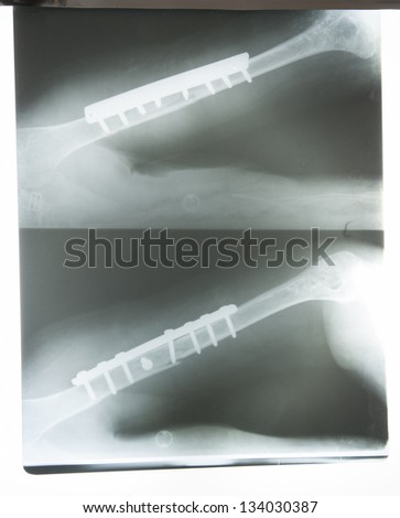 X-ray image in a hospital of a broken arm with metal pins through bone