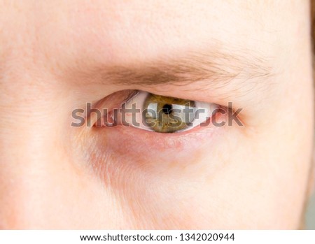Detail view of man green eye with heavy upper eyelid. Before Blepharoplasty surgery to correct Dermatochalasis concept. Royalty-Free Stock Photo #1342020944