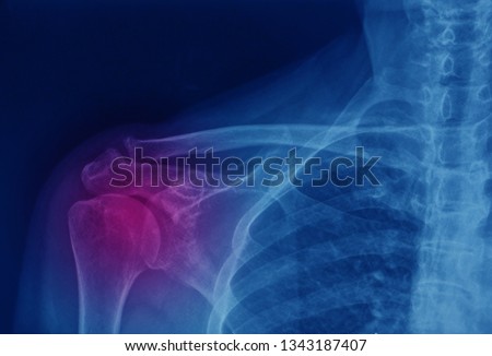 an x-ray image of right shoulder. the patient has pain due to rotator cuff tear. Royalty-Free Stock Photo #1343187407