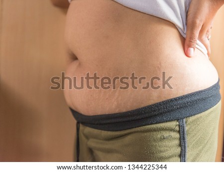 Picture close Up skin abdominal stretch after giving birth.
