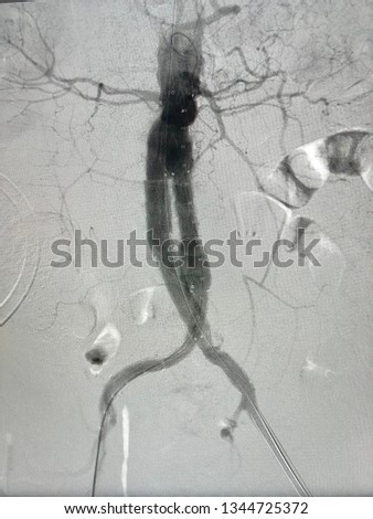 INFRARENAL-ABDOMINAL-AORTIC-ANEURYSM Stock Photos and Images - Avopix.com