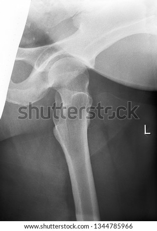 Adult left hip bone x ray black and white film photo slide Royalty-Free Stock Photo #1344785966