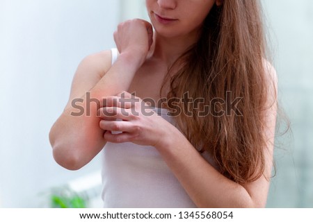 Young woman suffering from itching on her skin and scratching an itchy place. Allergic reaction to insect bites, dermatitis, food, drugs. Health care concept. Allergy rash  Royalty-Free Stock Photo #1345568054