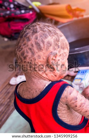 HARLEQUIN-ICHTHYOSIS Stock Photos and Images - Avopix.com