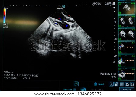 Modern medical equipment, ultrasound machine,Echocardiogramp.