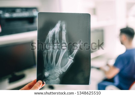 X-ray picture of a hand with a broken little finger, the concept of a neurosurgeon.