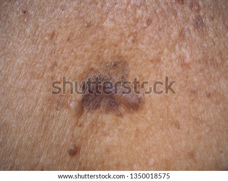Skin cancer or melanoma on collarbone type of superficial spreading be an existing spot, freckle or mole change color, size or shape caused by ultraviolet (UV) light damaging the DNA in skin cells. Royalty-Free Stock Photo #1350018575