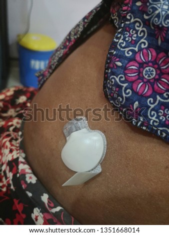 Continuous glucose monitoring pod. Technology for glucose check wireless  Royalty-Free Stock Photo #1351668014
