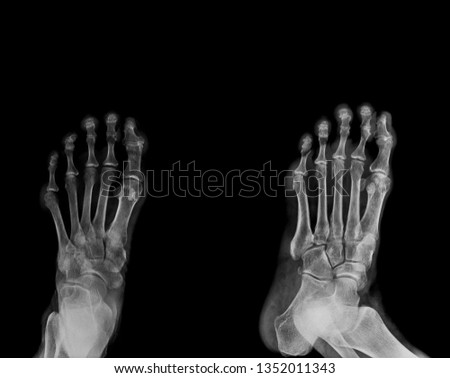 foot x-ray AP and lateral view 