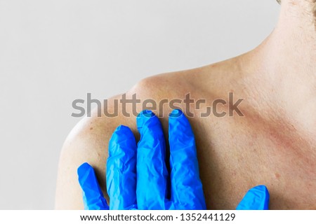 Dislocation or fracture of the clavicle and acromial process with displacement. The doctor examines the patient with a dislocation and fracture of the clavicle and acromial process, close-up Royalty-Free Stock Photo #1352441129