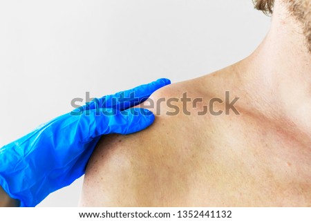 Dislocation or fracture of the clavicle and acromial process with displacement. The doctor examines the patient with a dislocation and fracture of the clavicle and acromial process, close-up Royalty-Free Stock Photo #1352441132