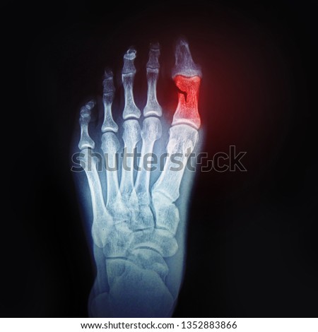 A broken toe. X-ray of the foot with the designation of the sore spot. Bone and joint health, concept