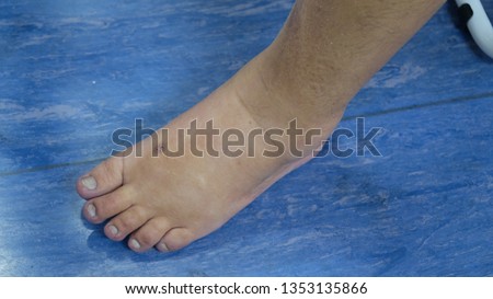 Leg Oedema in patient with heart failure. Royalty-Free Stock Photo #1353135866
