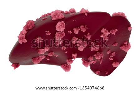 Hepatocellular Cancer (Hcc) Or Malignant (Cancerous) Nodules On A Liver. Medical Science And Research Concept, 3d rendering