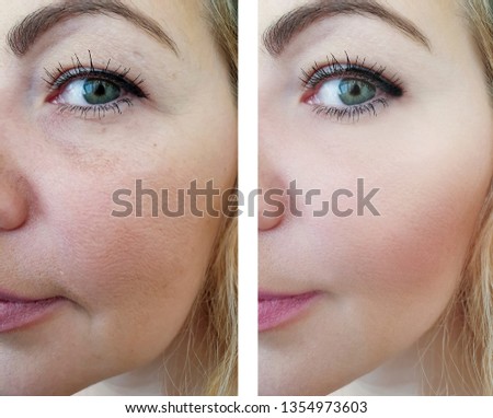 woman wrinkles   after procedures Royalty-Free Stock Photo #1354973603