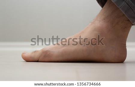 Flat feet (pes planus or fallen arches). close up of flat men foot. Royalty-Free Stock Photo #1356734666