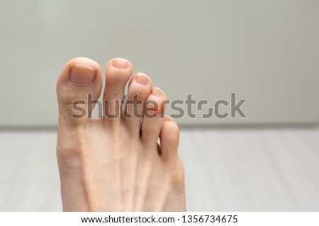 Close up a toes with red swelling Royalty-Free Stock Photo #1356734675