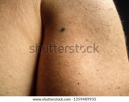 Point tattoo, left arm, made for the treatment of non-Hodgkin's lymphoma by radiotherapy. The treatment was in 2011, and this photo was taken in April 2019, in Brazil. Royalty-Free Stock Photo #1359489935