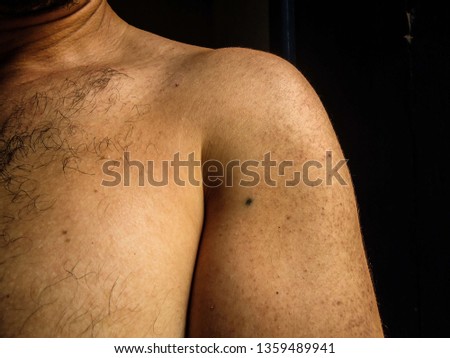 Point tattoo, left arm, made for the treatment of non-Hodgkin's lymphoma by radiotherapy. The treatment was in 2011, and this photo was taken in April 2019, in Brazil. Royalty-Free Stock Photo #1359489941