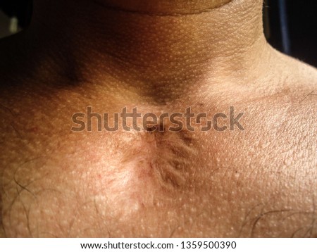 Scar tissue obtained after biopsy for the treatment of non-Hodgkin's lymphoma. The treatment was in 2011, and this photo was taken in April 2019 in Brazil. Royalty-Free Stock Photo #1359500390