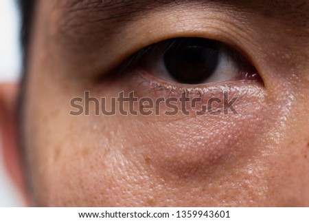 Ptosis (Droopy eyelid) in asian male oily skin type with dark eye bag Royalty-Free Stock Photo #1359943601