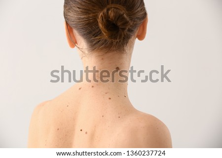 Young woman with moles on light background Royalty-Free Stock Photo #1360237724