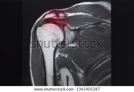 A coronal view of magnetic resonance image or MRI of shoulder showing rotator cuff tendon tear. Red highlight focused on the tear tendon. the patient has chronic shoulder pain. Royalty-Free Stock Photo #1365405287