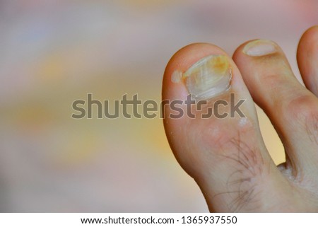 Damaged toenail. The thumb on the man's leg. Ugly, sick, injured and broken nail on the foot. 