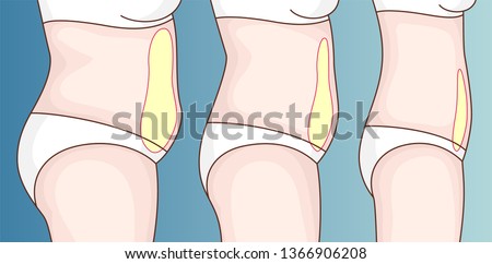 Fat on the belly. Reducing fat in the abdominal area. Overweight. Royalty-Free Stock Photo #1366906208