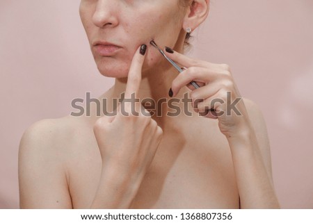 Woman with problem skin. Teen acne on young skin. Tools for removing acne.