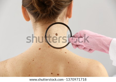Dermatologist examining moles of patient on light background Royalty-Free Stock Photo #1370971718