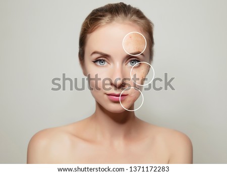 woman face portrait with clear and pimpled skin / skin treatment products concept for design Royalty-Free Stock Photo #1371172283