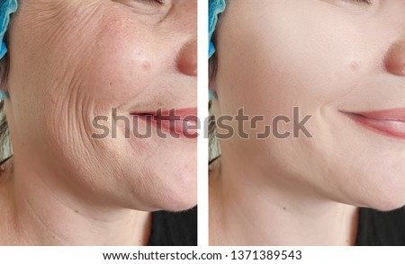 woman wrinkles   after procedures Royalty-Free Stock Photo #1371389543