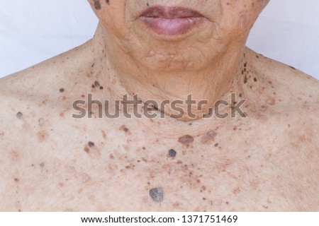 Liver Spot Stock Photos And Images Avopix Com