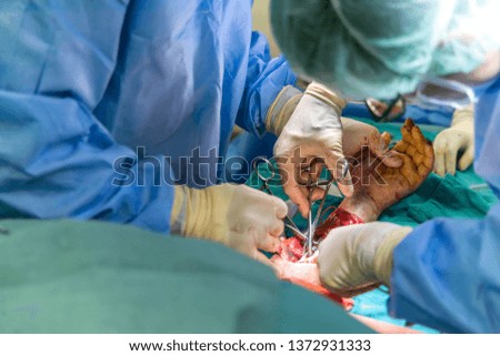 Orthopedic surgeon doing open reduction to fixation the broken bone inside the operating room under light from surgical lamp. The team of doctor fixed the ulnar bone with plate.Medical concept.
