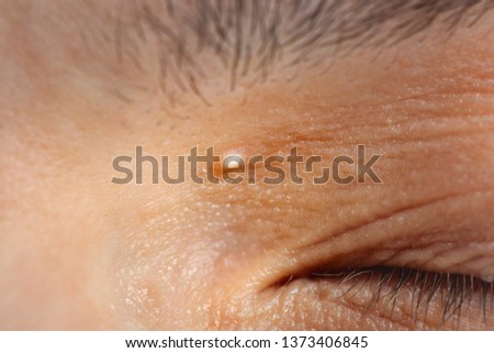 Milia on the skin of the face (also called a milium, plural milia, milk spot or an oil seed). Macro shot. Royalty-Free Stock Photo #1373406845