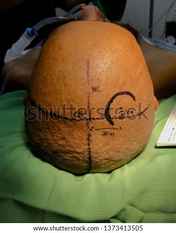 hydrocephalus landmarks of incision showing the midline, coronal suture and the kocher's curvilinear incision.