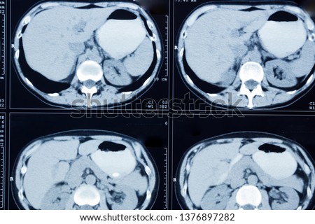 T.A.C. Computerized axial tomography of the female human abdomen. Royalty-Free Stock Photo #1376897282