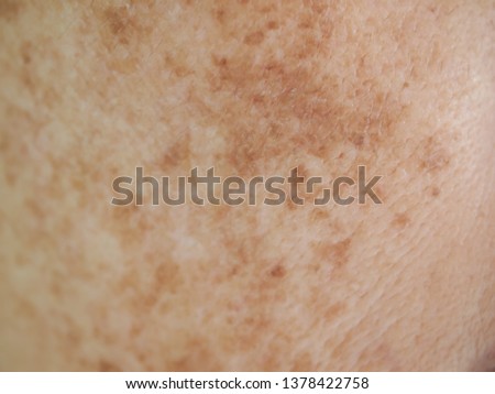 Problem skincare and health concept. Closeup wrinkles, melasma, Dark spots, freckles, dry skin ,pigment on asian woman face texture background.  Royalty-Free Stock Photo #1378422758