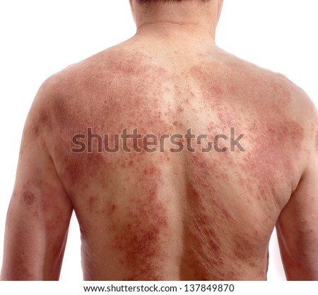 back view of man with dermatitis  problem of rash and itchy dry skin. 