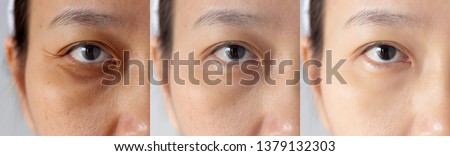 three pictures compared effect Before and After treatment. under eyes with problems of dark circles ,puffiness and wrinkles periorbital before and after treatment to solve skin problem for better skin Royalty-Free Stock Photo #1379132303
