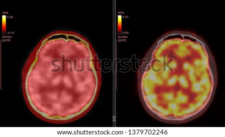 PET CT scan of Human Brain (Axial view Positron Emission Tomography)  High Resolution