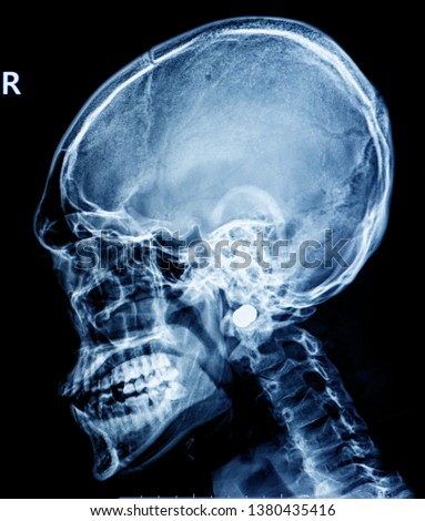 Film x-ray skull ,human's skull
